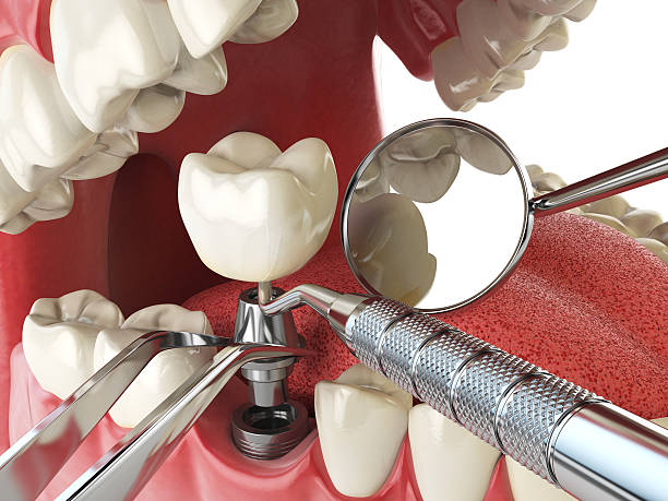 Best Emergency Root Canal Treatment in Holley, NY